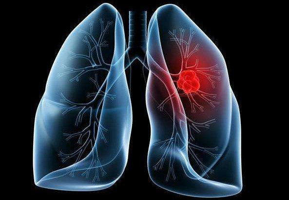 肺癌2.jpg